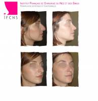 Dr Azan & Dr Susini -  Chirurgien ORL spécialisé en rhinoplastie