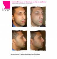 Dr Azan & Dr Susini -  Chirurgie pour une greffe de peau sur le nez