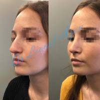 Dr Azan & Dr Susini -  Prix pour réaliser une intervention de rhinoplastie secondaire