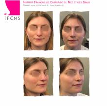 Dr Azan & Dr Susini -  Chirurgien spécialiste en rhinoplastie pour embellir son nez