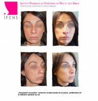 Dr Azan & Dr Susini -  Chirurgien spécialiste en rhinoplastie pour embellir son nez