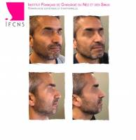 Dr Azan & Dr Susini -  Prix pour opérer un nez cassé