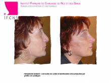 Dr Azan & Dr Susini -  Chirurgien plasticien pour un traumatisme nasal